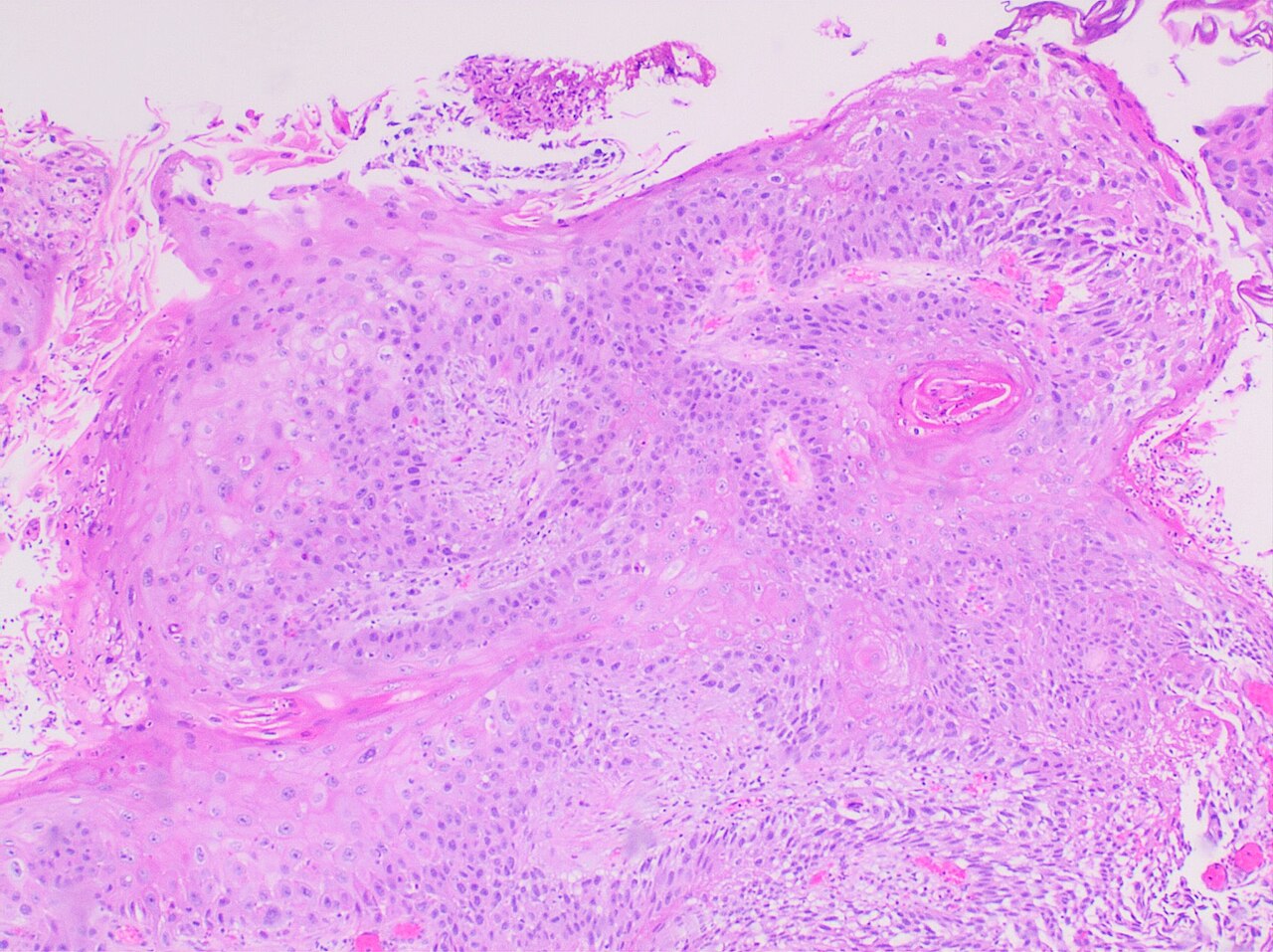 Histopathology of keratinizing squamous cell carcinoma of th