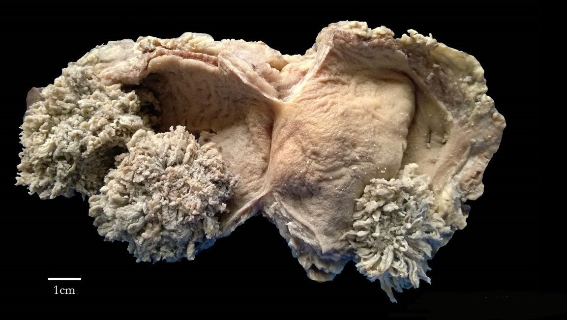 Gross pathology of papillary urothelial carcinoma of bladder