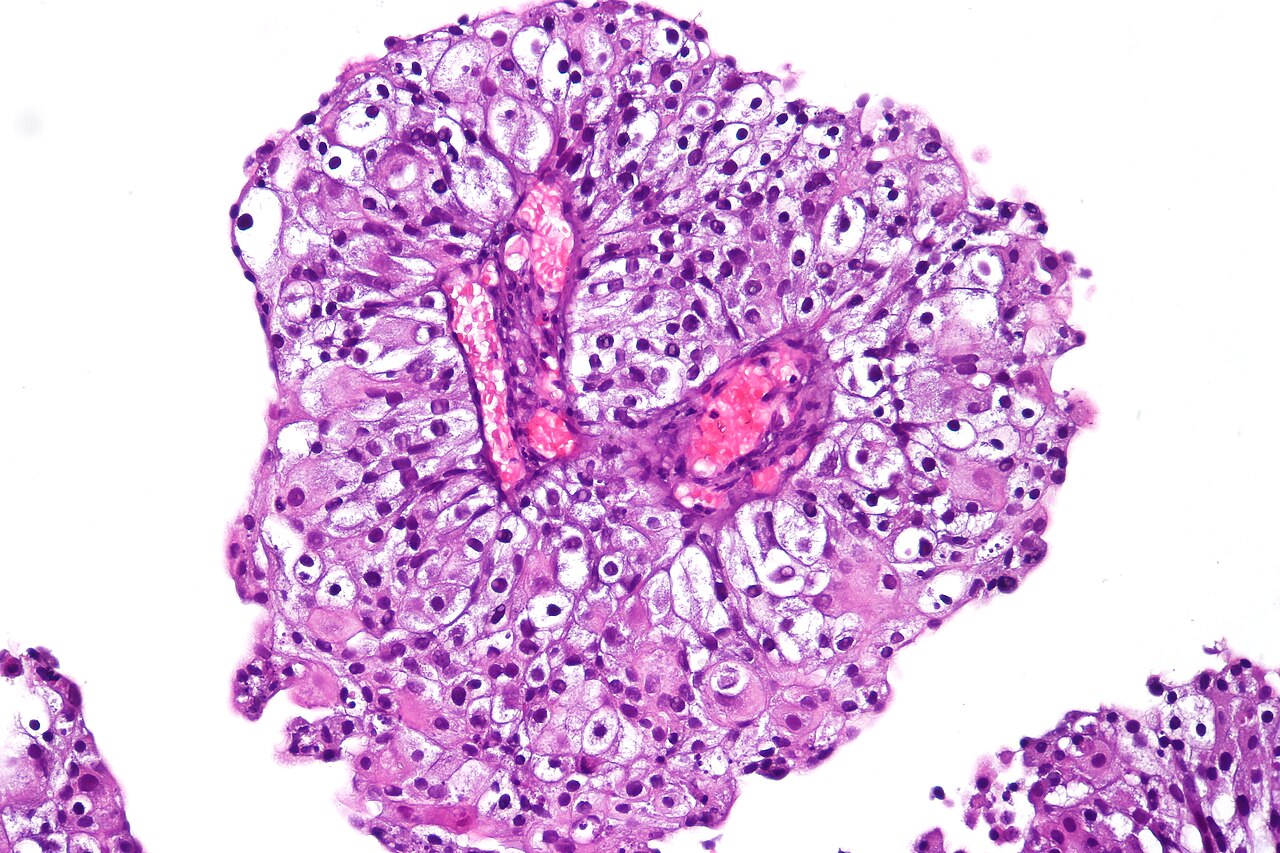 Clear cell papillary urothelial carcinoma h amp e stain