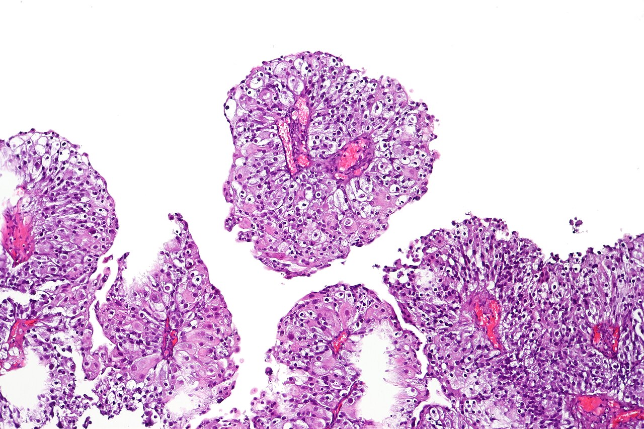 Clear cell papillary urothelial carcinoma h amp e stain