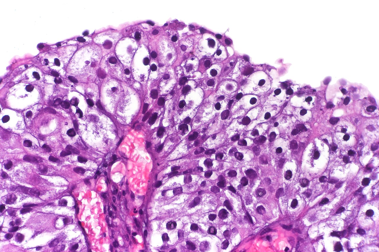 Clear cell papillary urothelial carcinoma h amp e stain