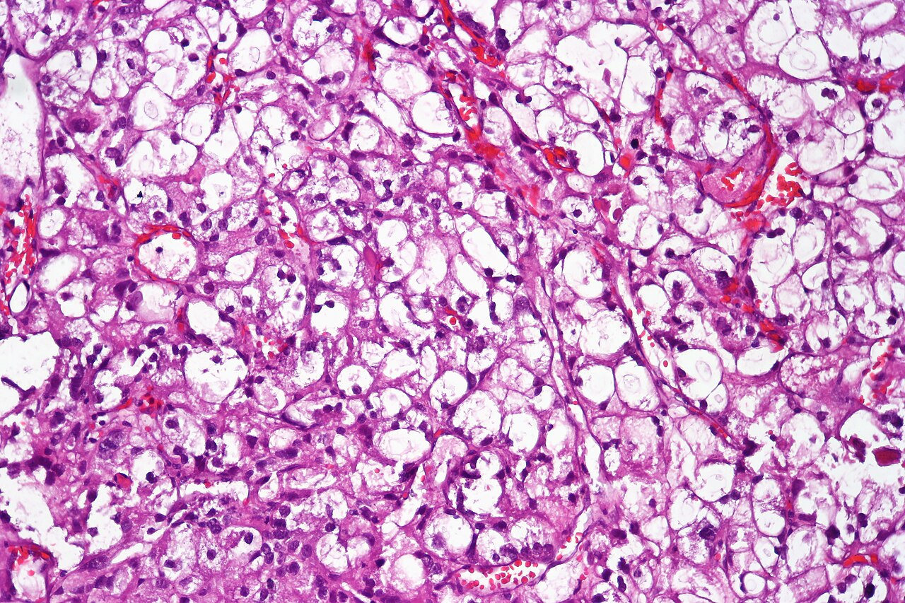 Clear cell urothelial carcinoma displaying cells with abunda