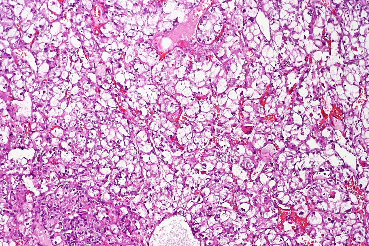 Clear cell urothelial carcinoma displaying cells with abunda