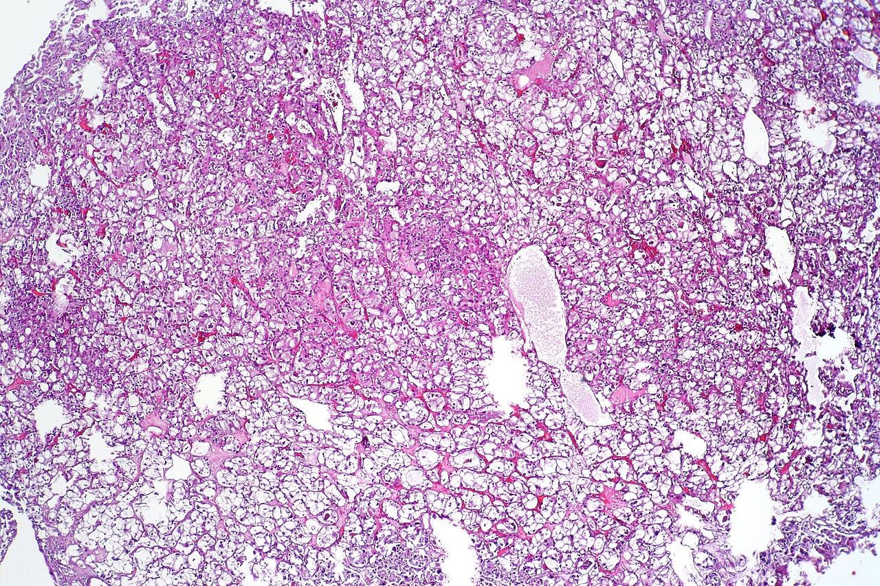 Clear cell urothelial carcinoma displaying cells with abunda