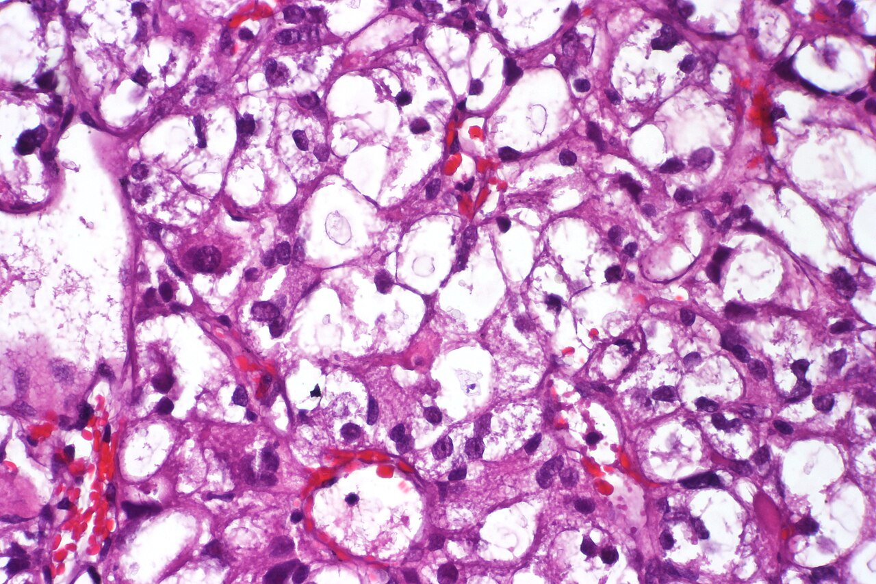 Clear cell urothelial carcinoma displaying cells with abunda