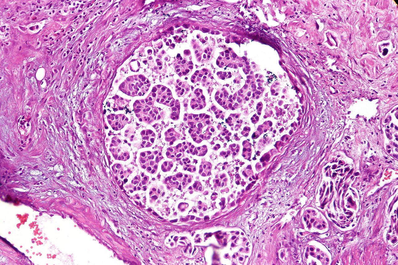 Micropapillary urothelial carcinoma characterized by micropa