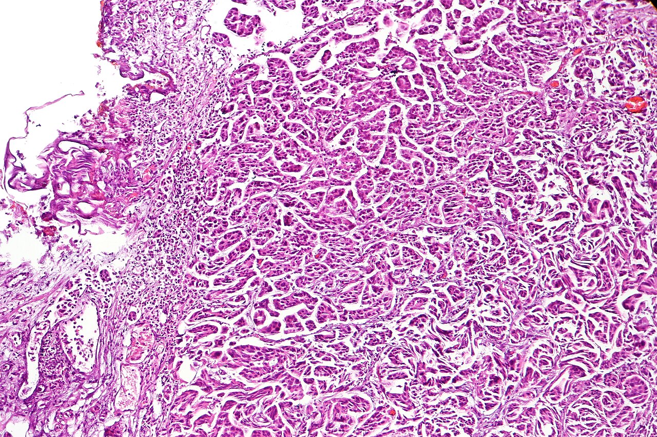 Micropapillary urothelial carcinoma characterized by micropa