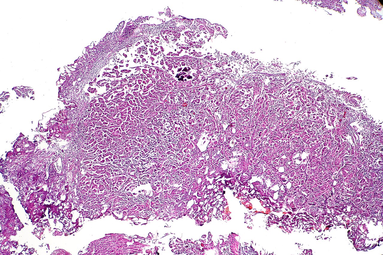Micropapillary urothelial carcinoma characterized by micropa