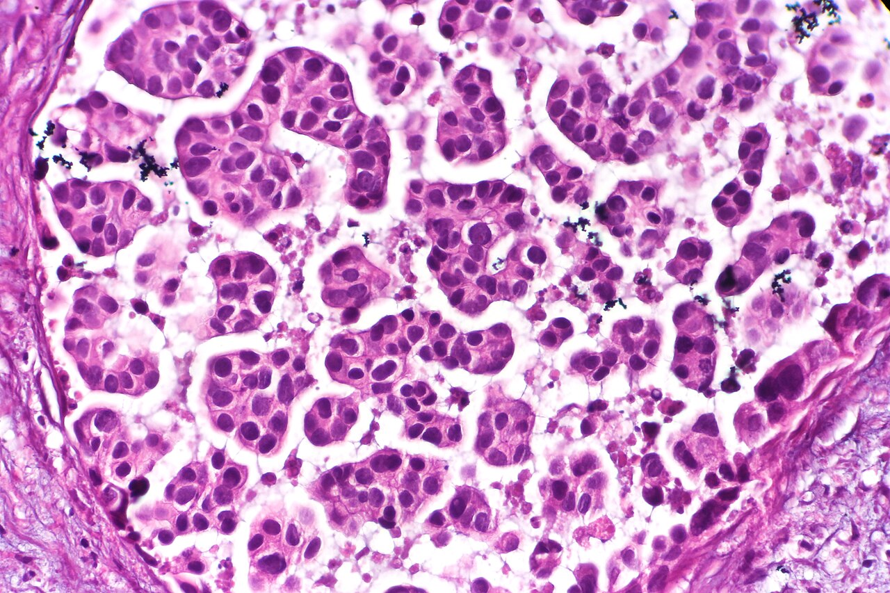 Micropapillary urothelial carcinoma characterized by micropa