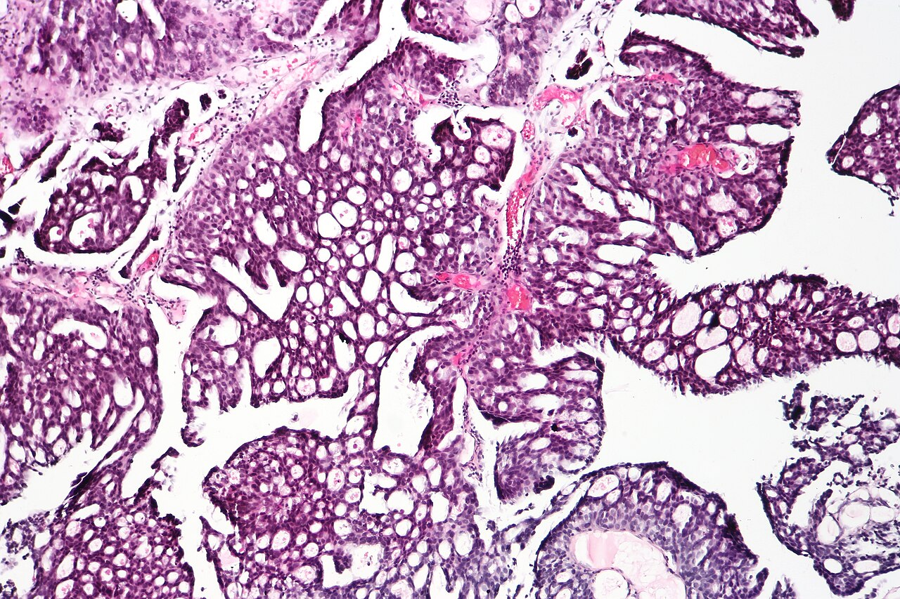 Papillary urothelial carcinoma showing a cribriform morpholo