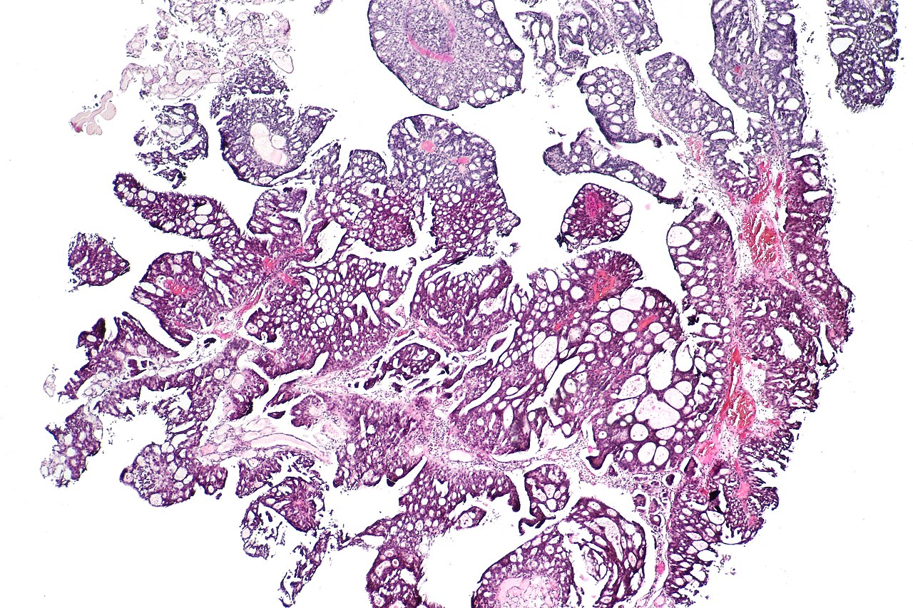 Papillary urothelial carcinoma showing a cribriform morpholo