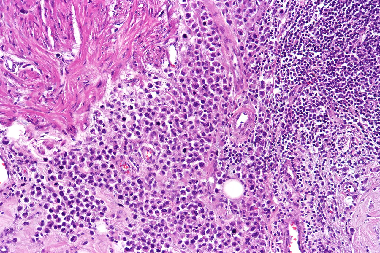 Plasmacytoid urothelial carcinoma showing monotonous discohe