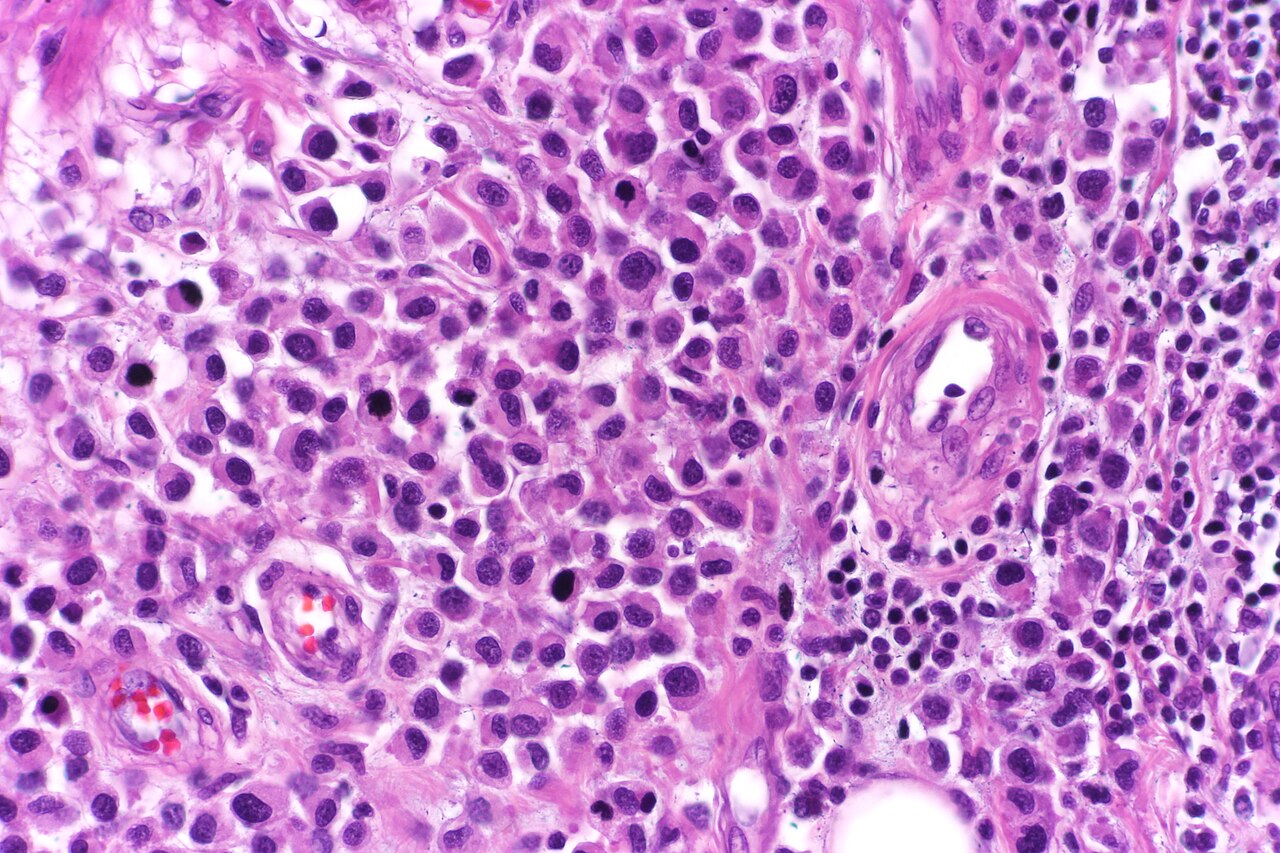 Plasmacytoid urothelial carcinoma showing monotonous discohe