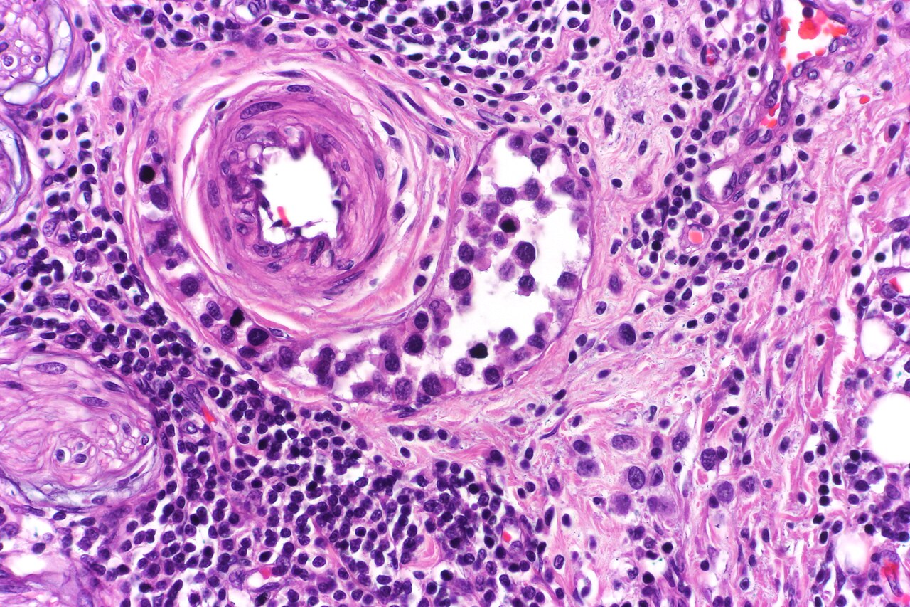Plasmacytoid urothelial carcinoma with lymphovascular invasi