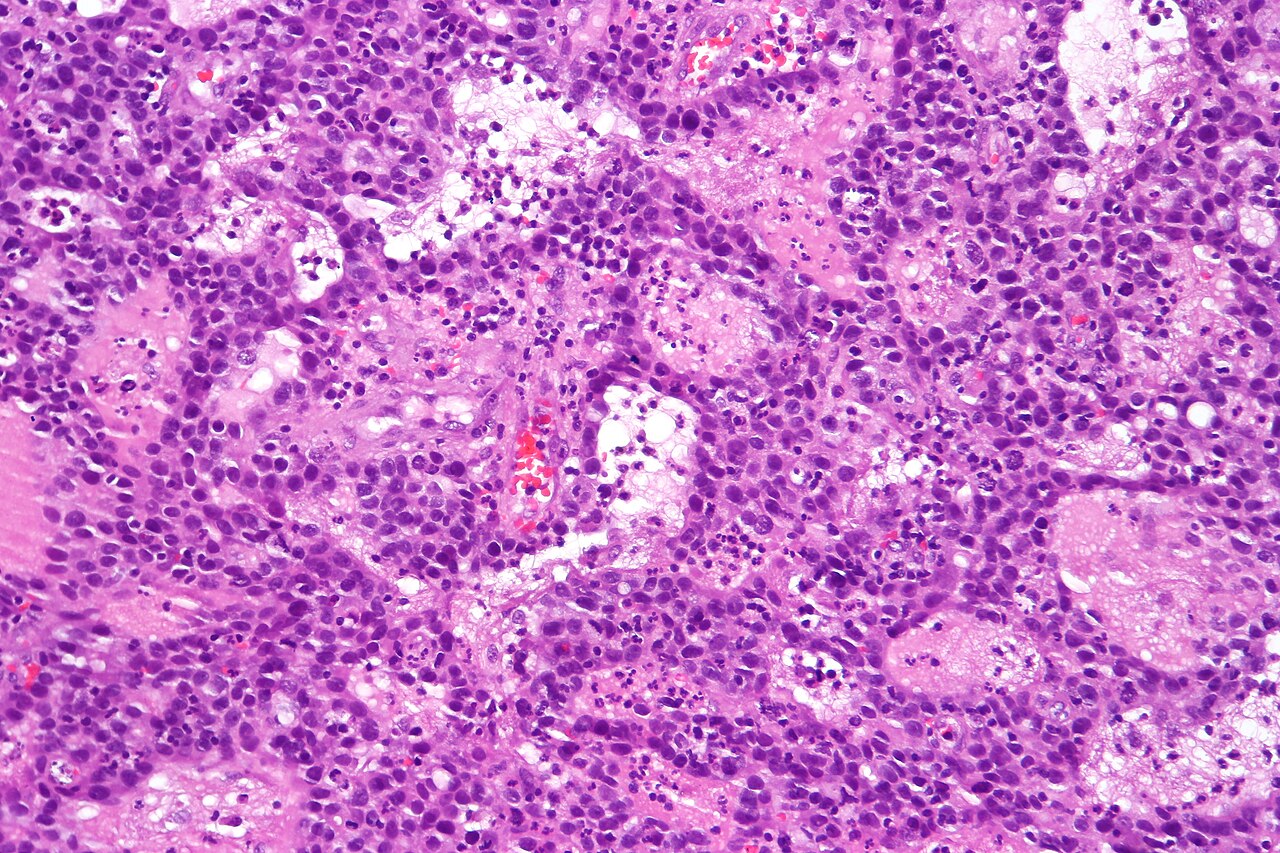 Urothelial carcinoma with glandular differentiation showing
