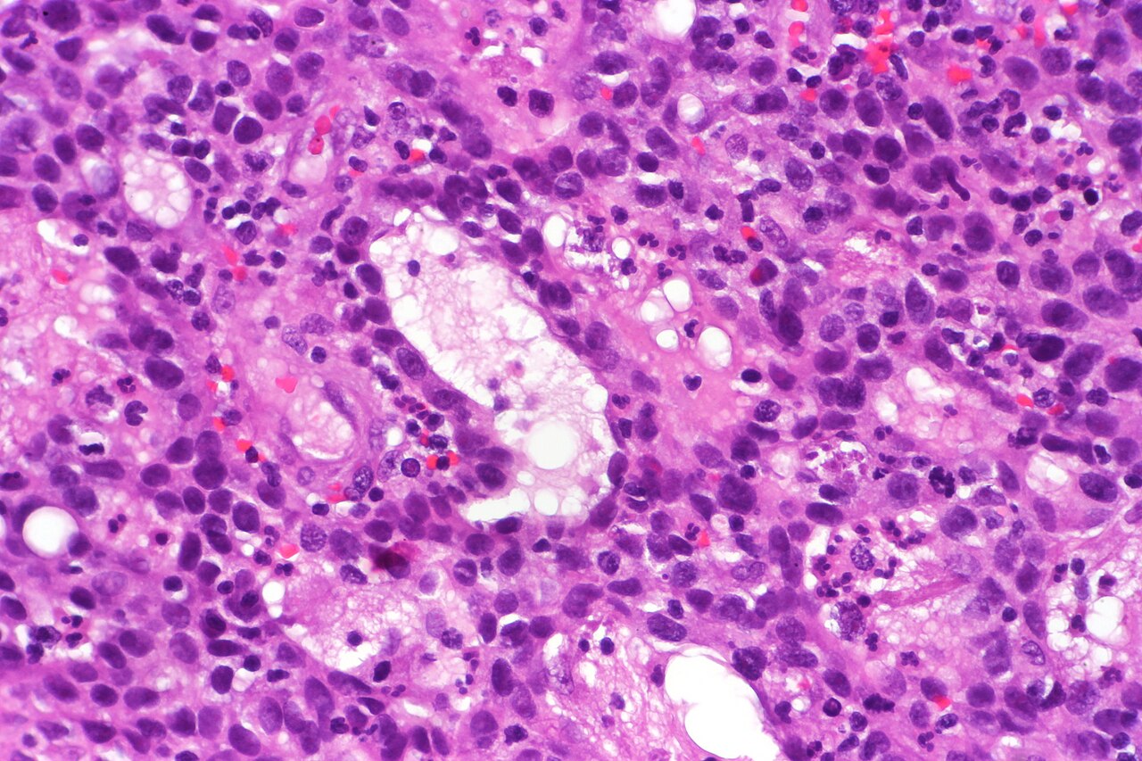 Urothelial carcinoma with glandular differentiation showing