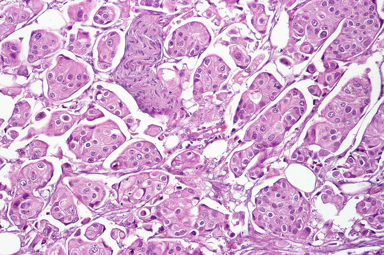 Micropapillary urothelial carcinoma in a resection specimen