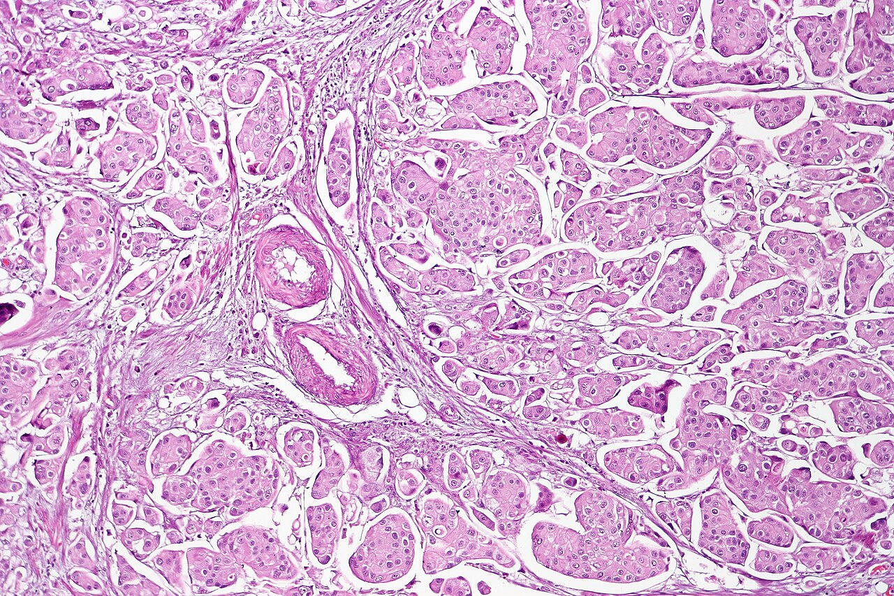 Micropapillary urothelial carcinoma in a resection specimen