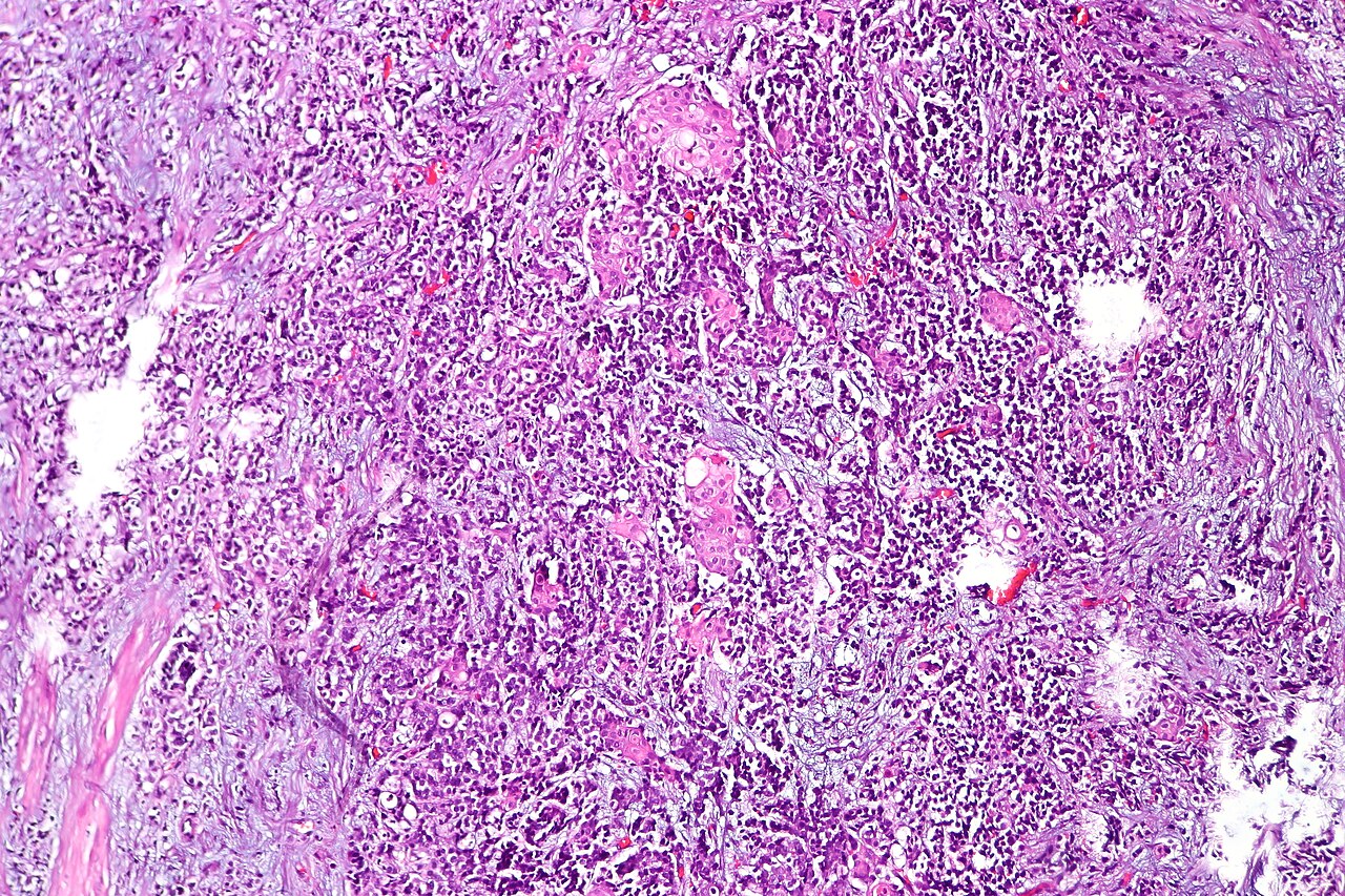 Urothelial carcinoma with squamous differentiation h amp e s