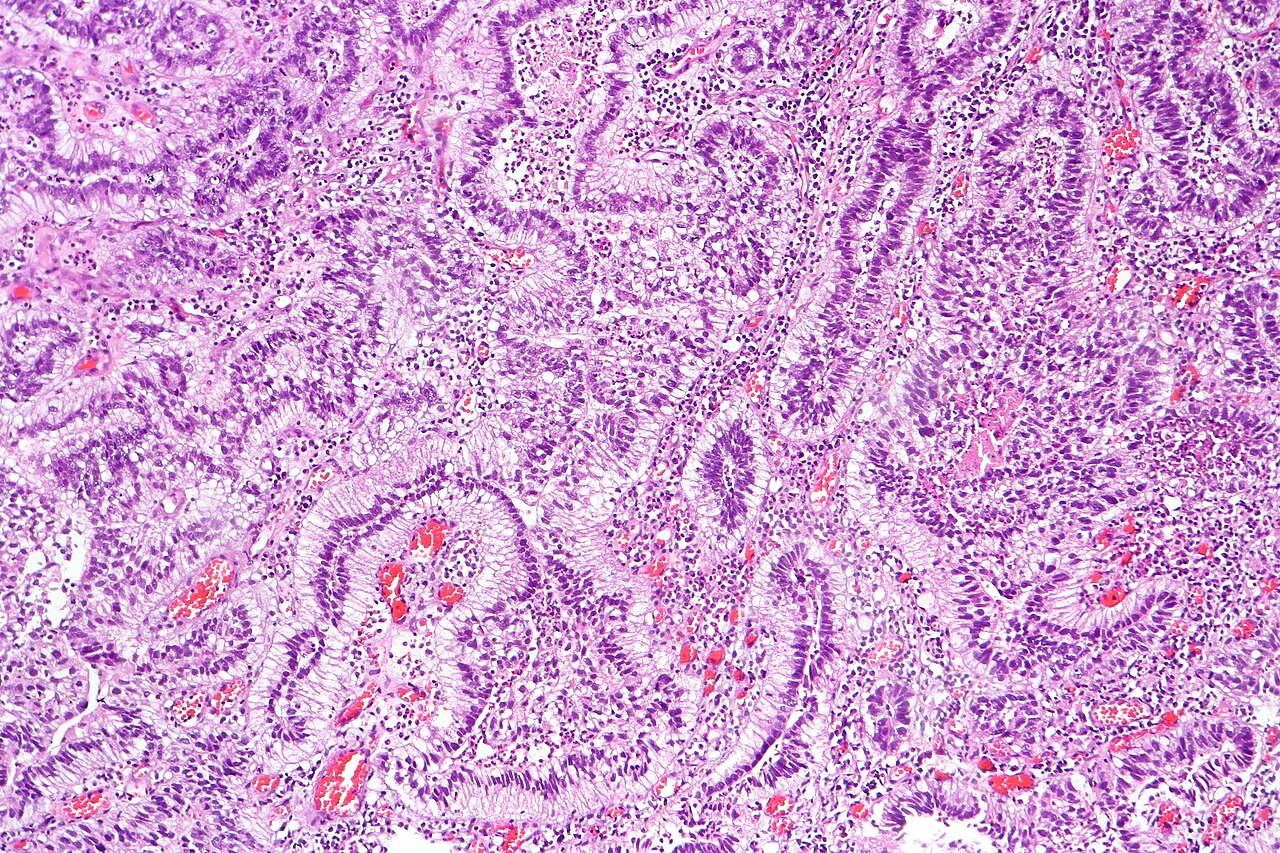 Urothelial carcinoma showing glandular differentiation and v
