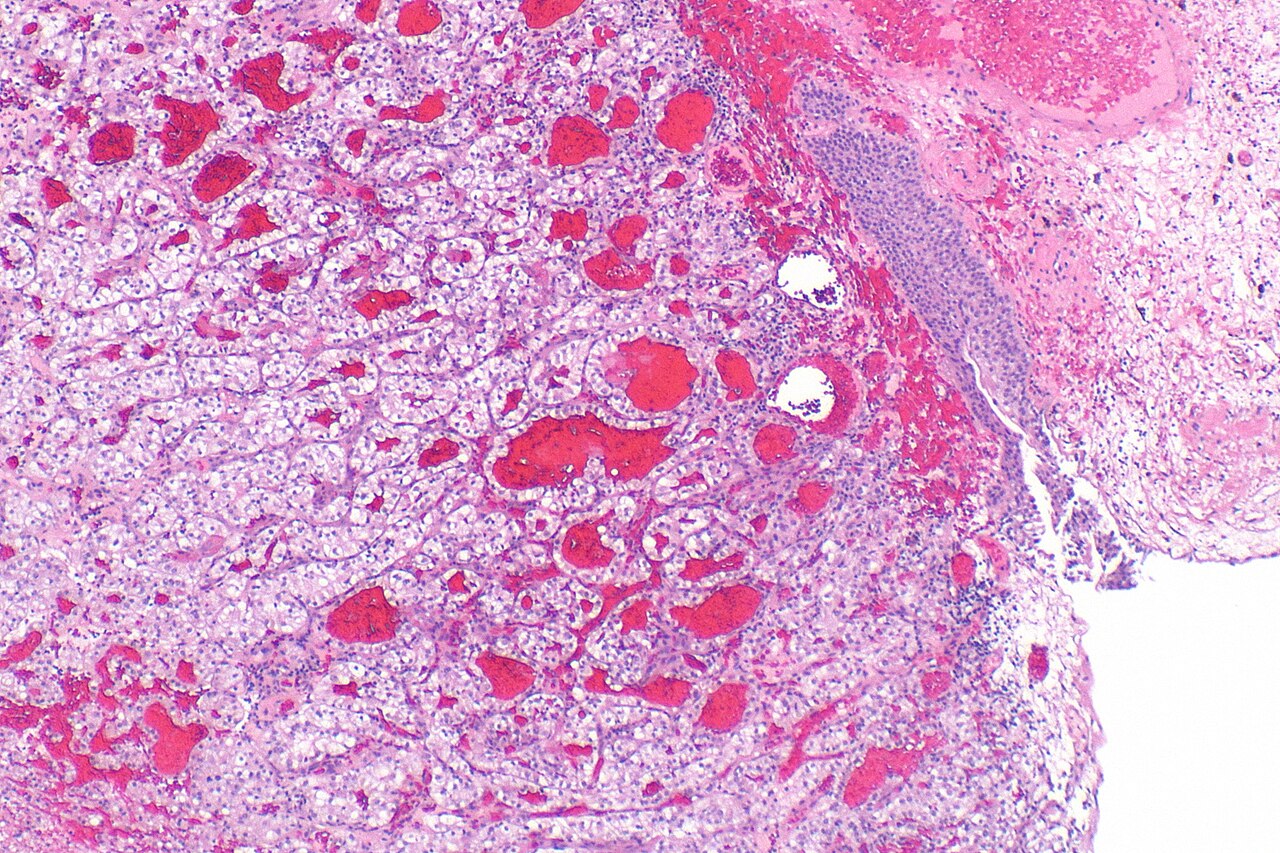 Micrograph showing metastatic clear cell renal cell carcinom