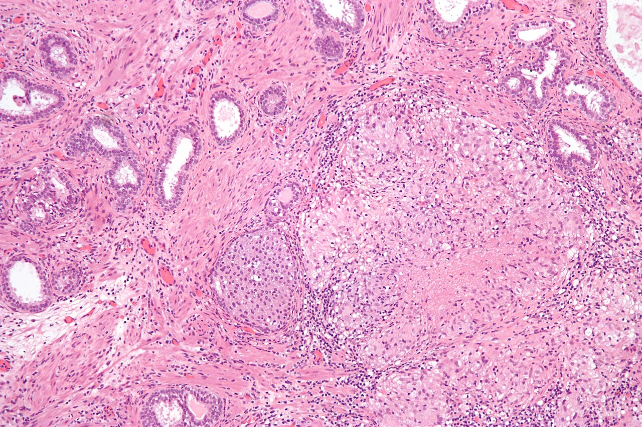 Micrograph of granulomatous inflammation of the urinary blad