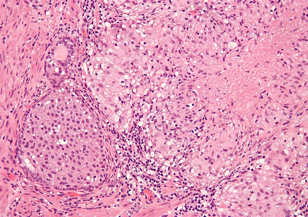 High magnification micrograph of granulomatous inflammation