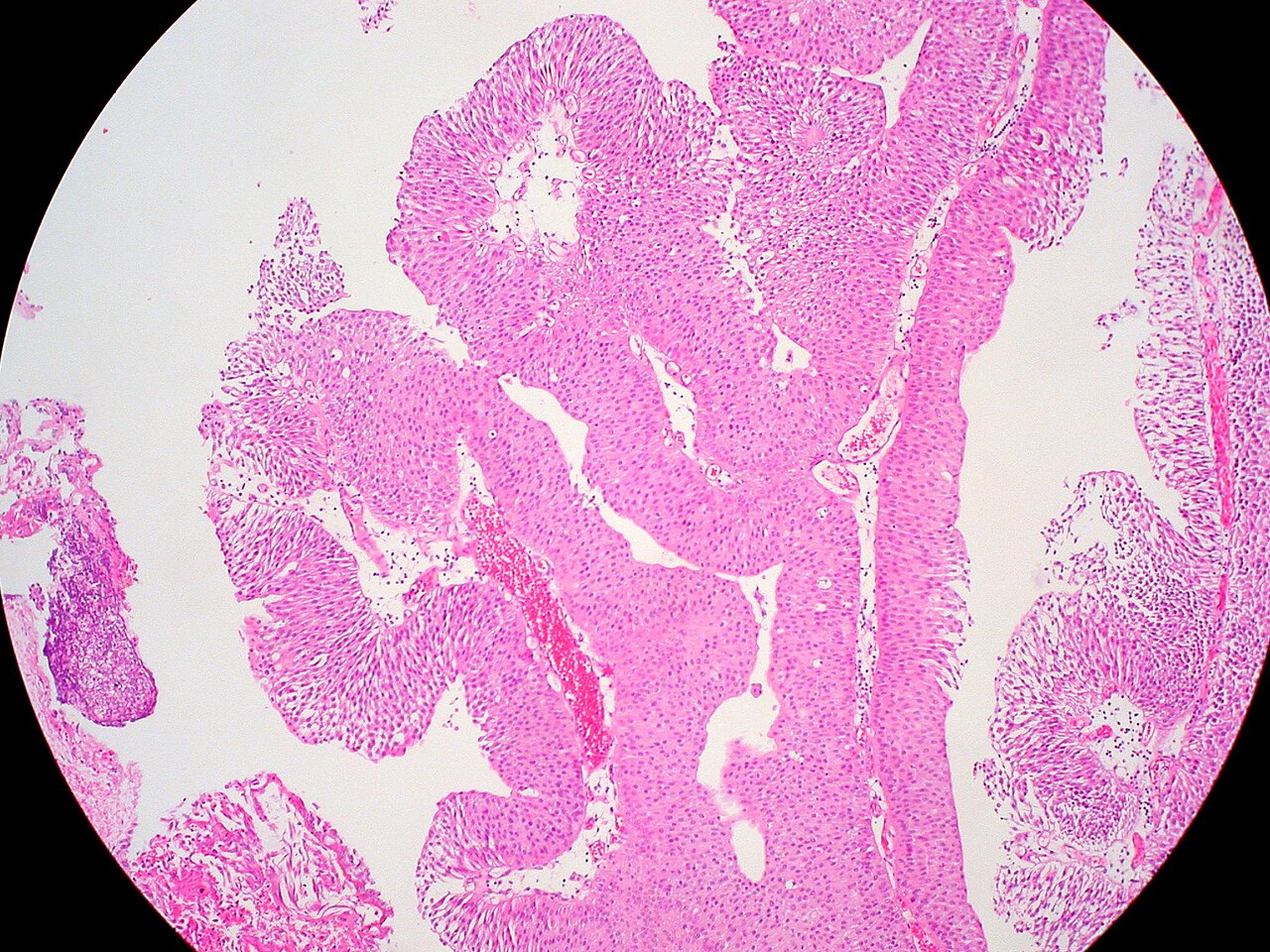 H amp e representative low power view of the tumor without t