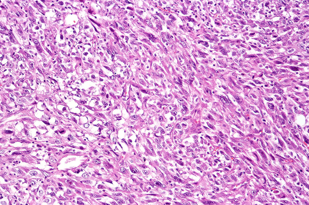 Sarcomatoid carcinoma of the urinary bladder tur specimen h