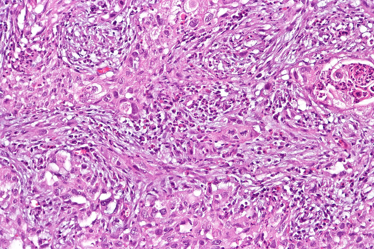 Sarcomatoid carcinoma of the urinary bladder featuring fasci