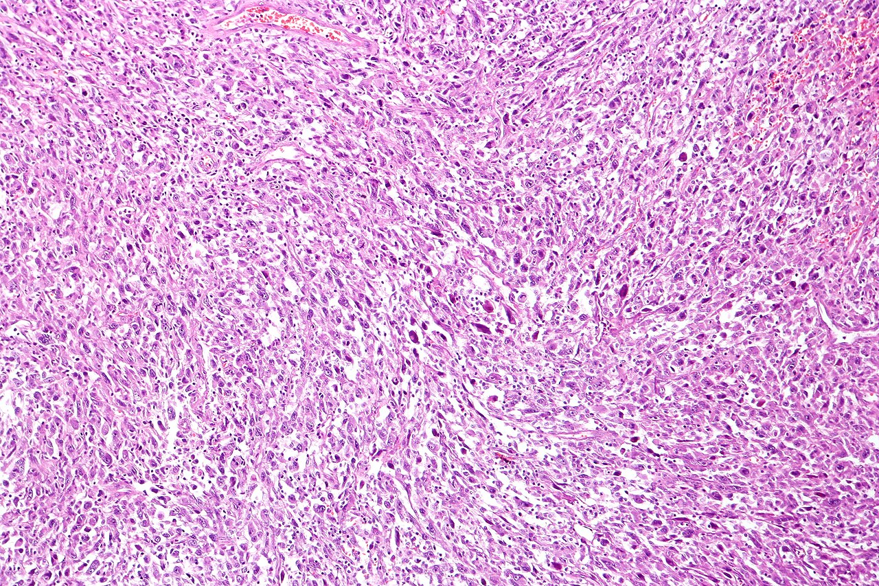 Sarcomatoid carcinoma of the urinary bladder tur specimen h