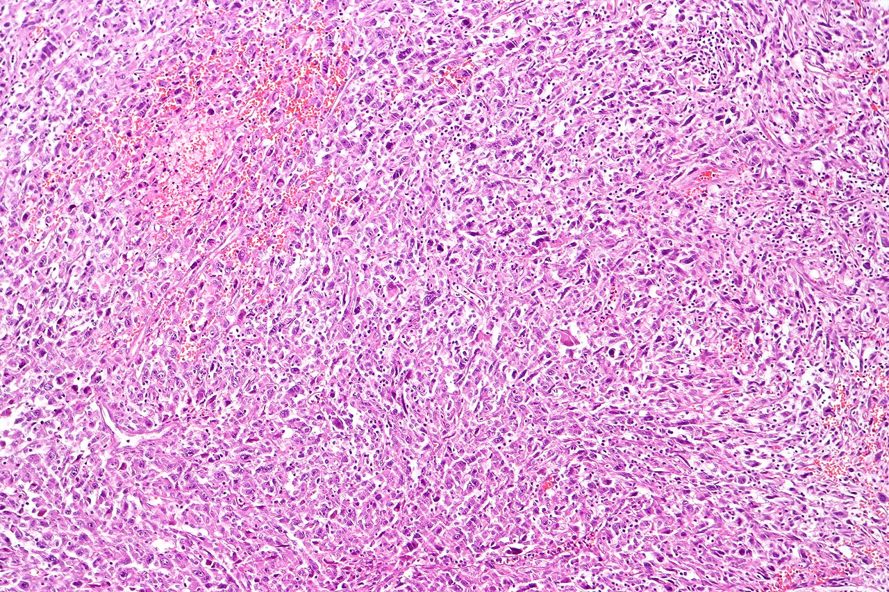 Sarcomatoid carcinoma of the urinary bladder tur specimen h