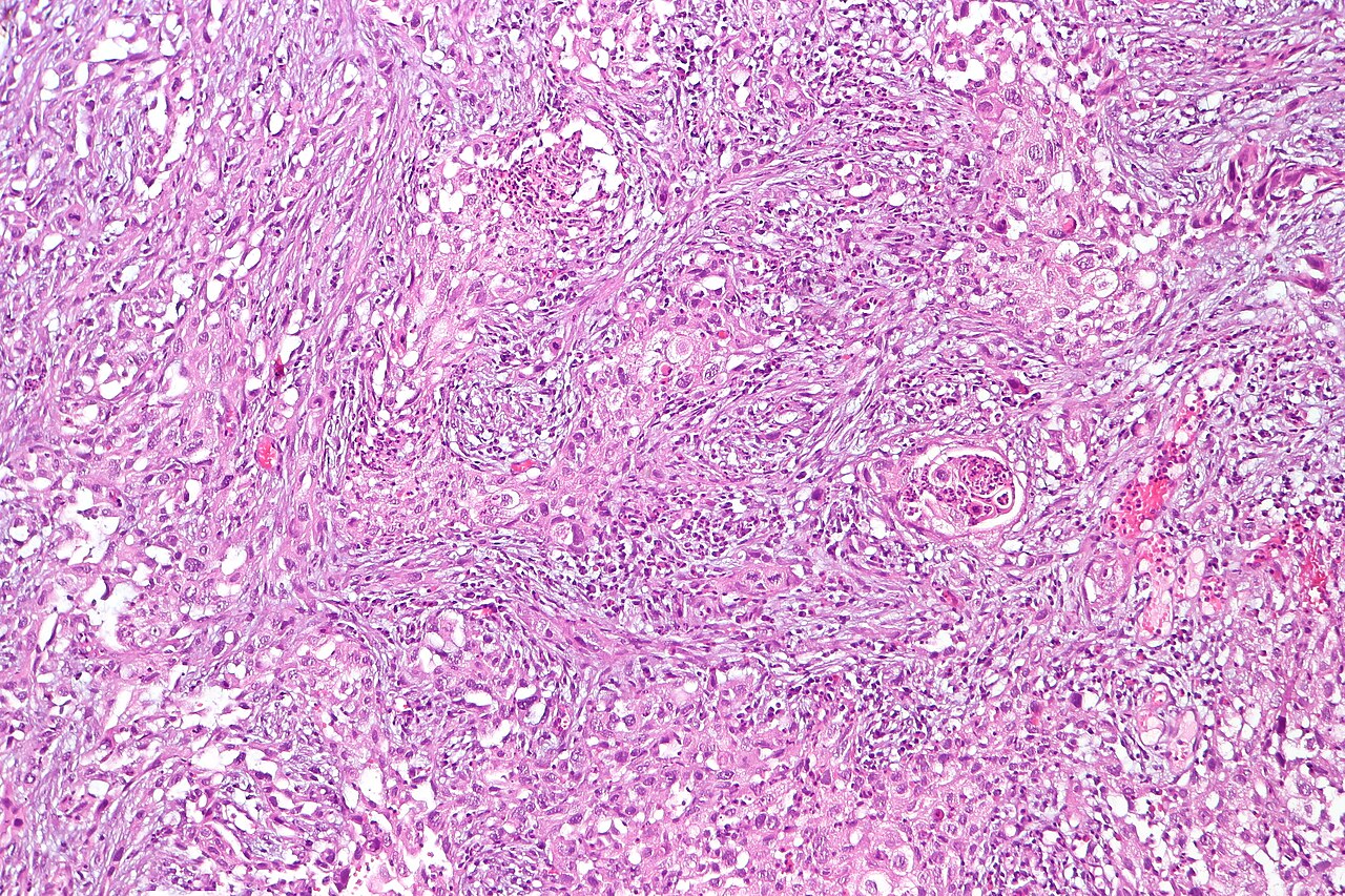 Sarcomatoid carcinoma of the urinary bladder featuring fasci