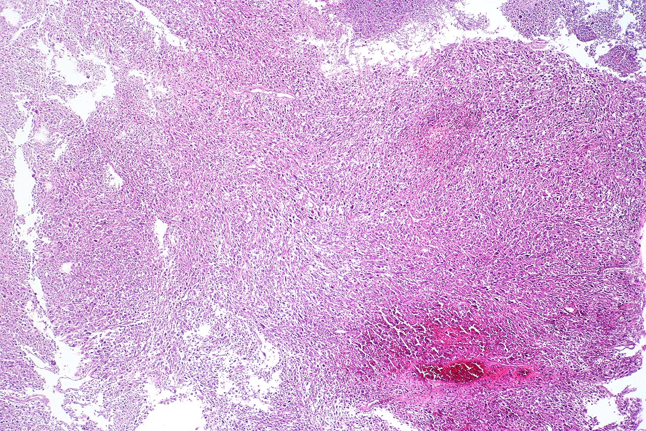 Sarcomatoid carcinoma of the urinary bladder tur specimen h