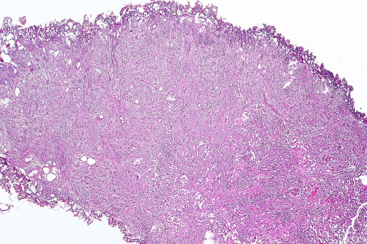 Sarcomatoid carcinoma of the urinary bladder featuring fasci