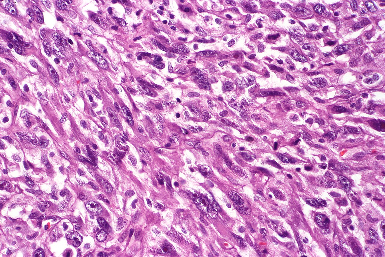 Sarcomatoid carcinoma of the urinary bladder tur specimen h
