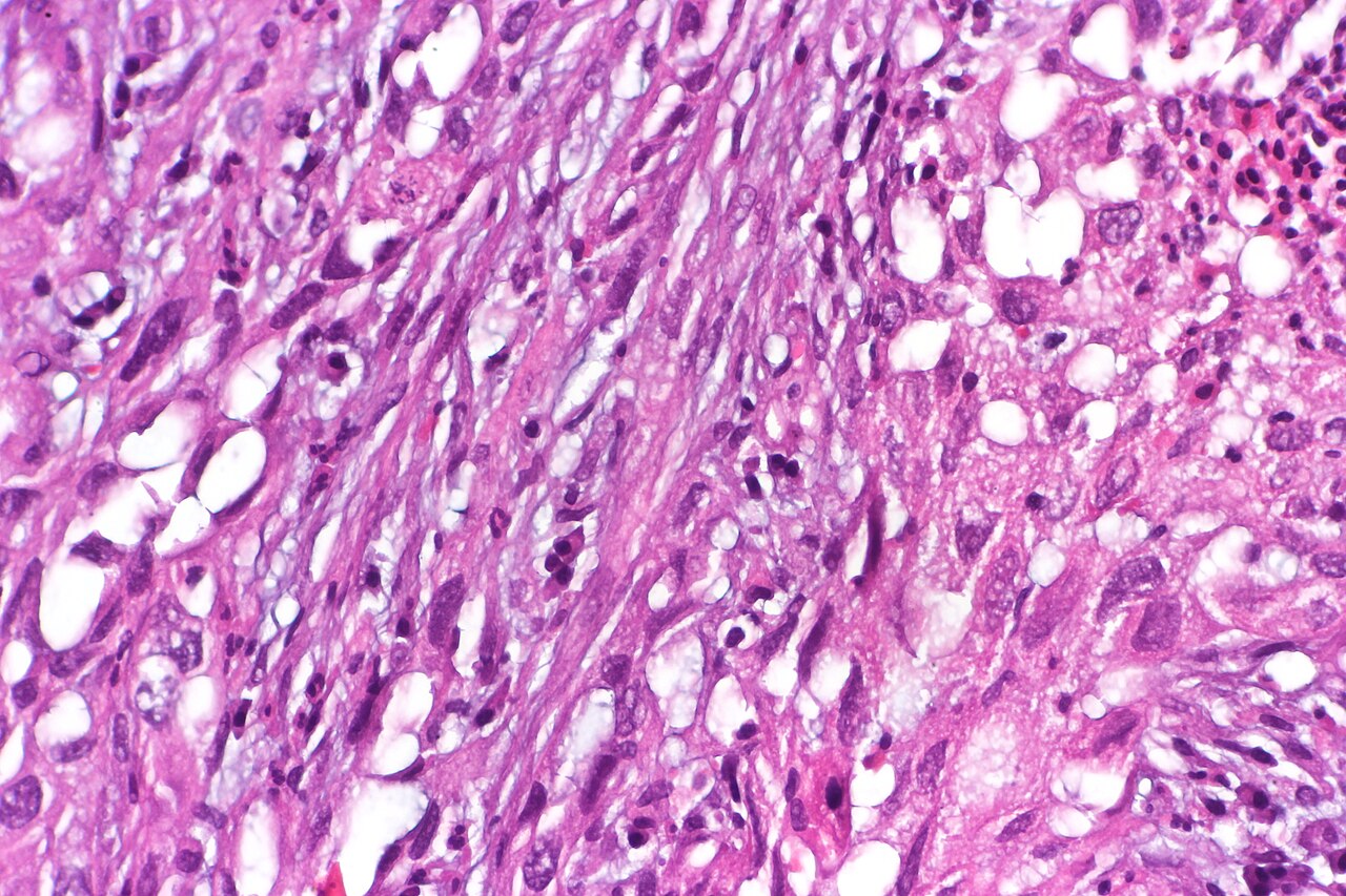 Sarcomatoid carcinoma of the urinary bladder featuring fasci