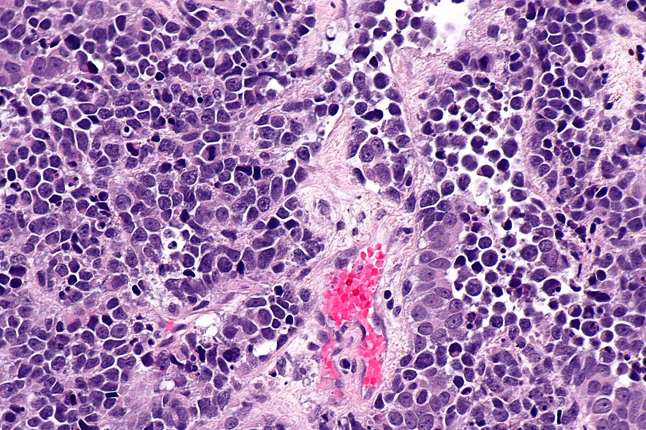 Micrograph of small cell carcinoma of the urinary bladder h