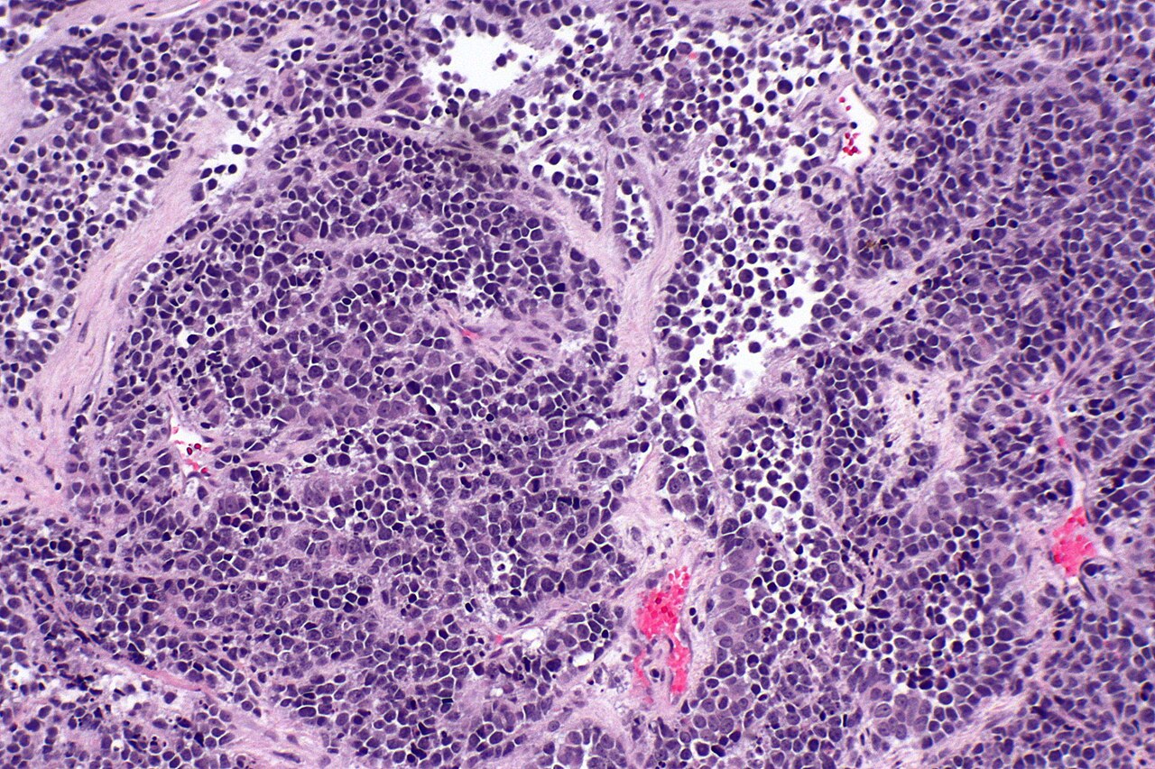 Micrograph of small cell carcinoma of the urinary bladder h