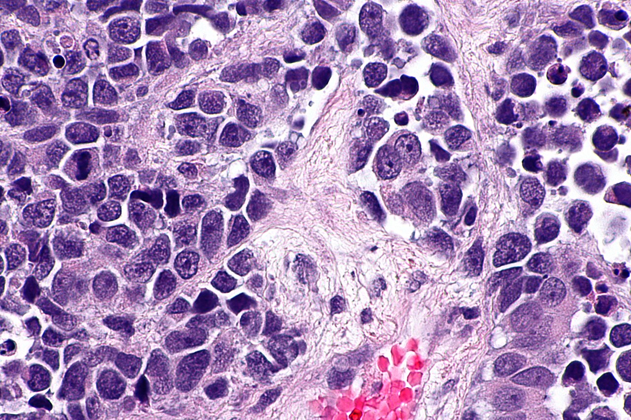 Micrograph of small cell carcinoma of the urinary bladder h