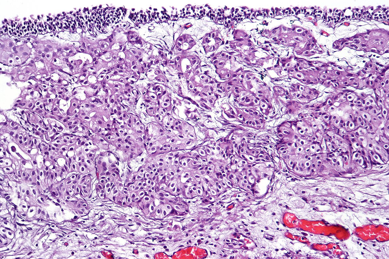 Urothelial carcinoma nested variant showing deceptively beni