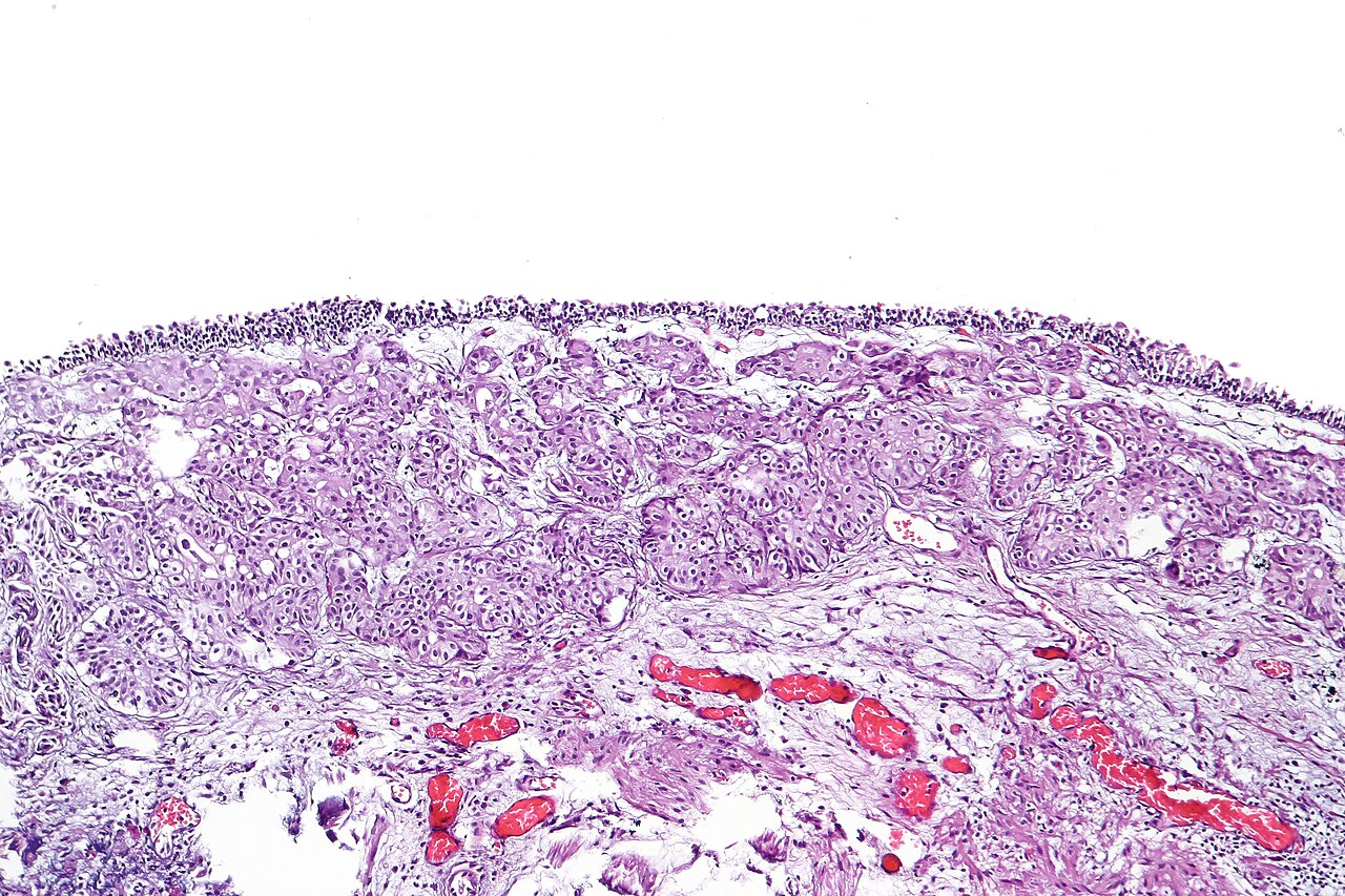 Urothelial carcinoma nested variant showing deceptively beni