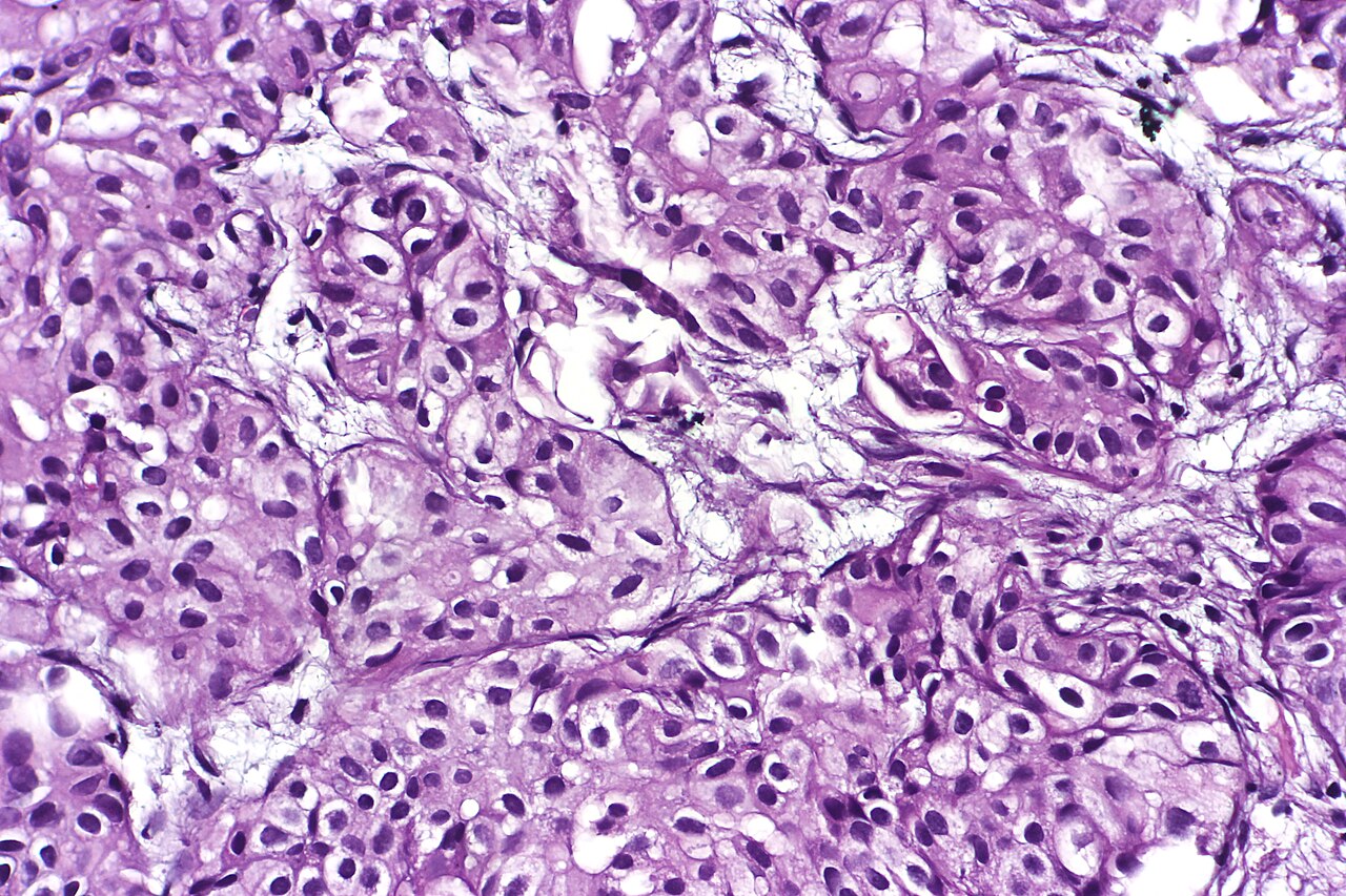 Urothelial carcinoma nested variant showing deceptively beni