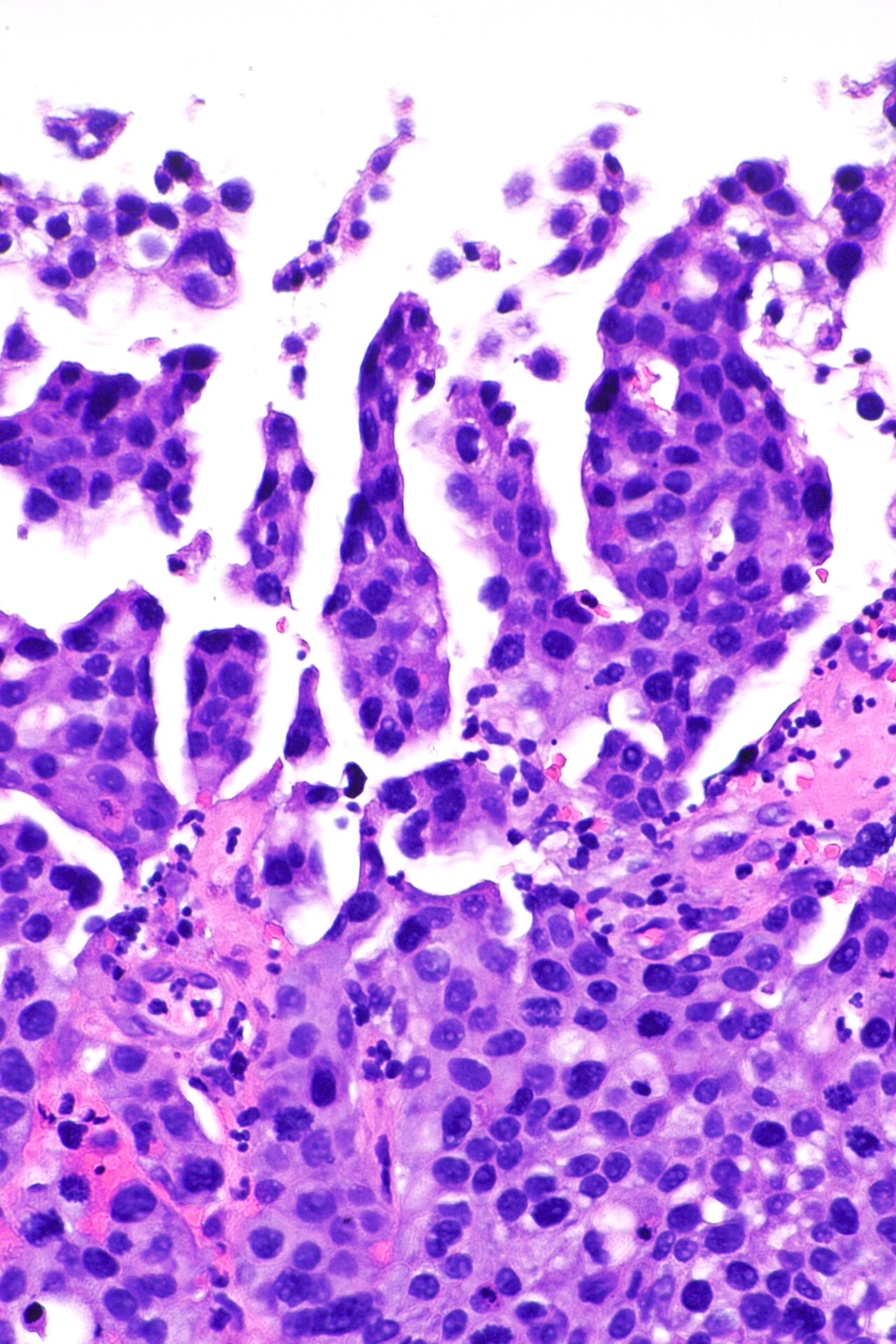 Micrograph showing micropapillary urothelial carcinoma also
