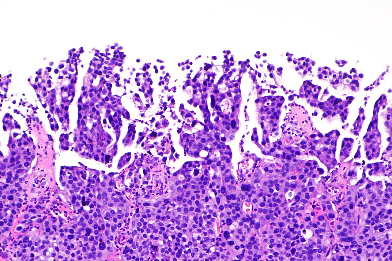 Micrograph showing micropapillary urothelial carcinoma also