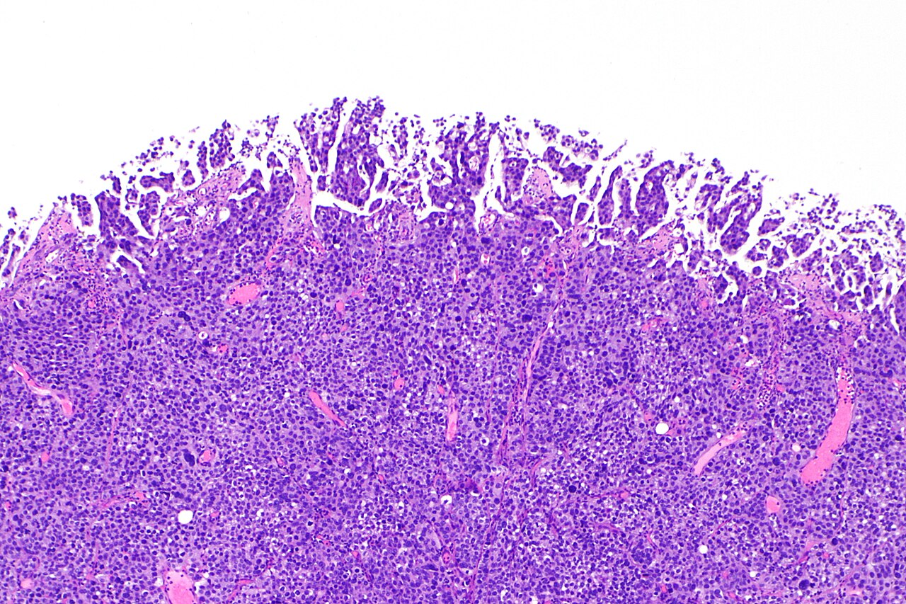 Micrograph showing micropapillary urothelial carcinoma also