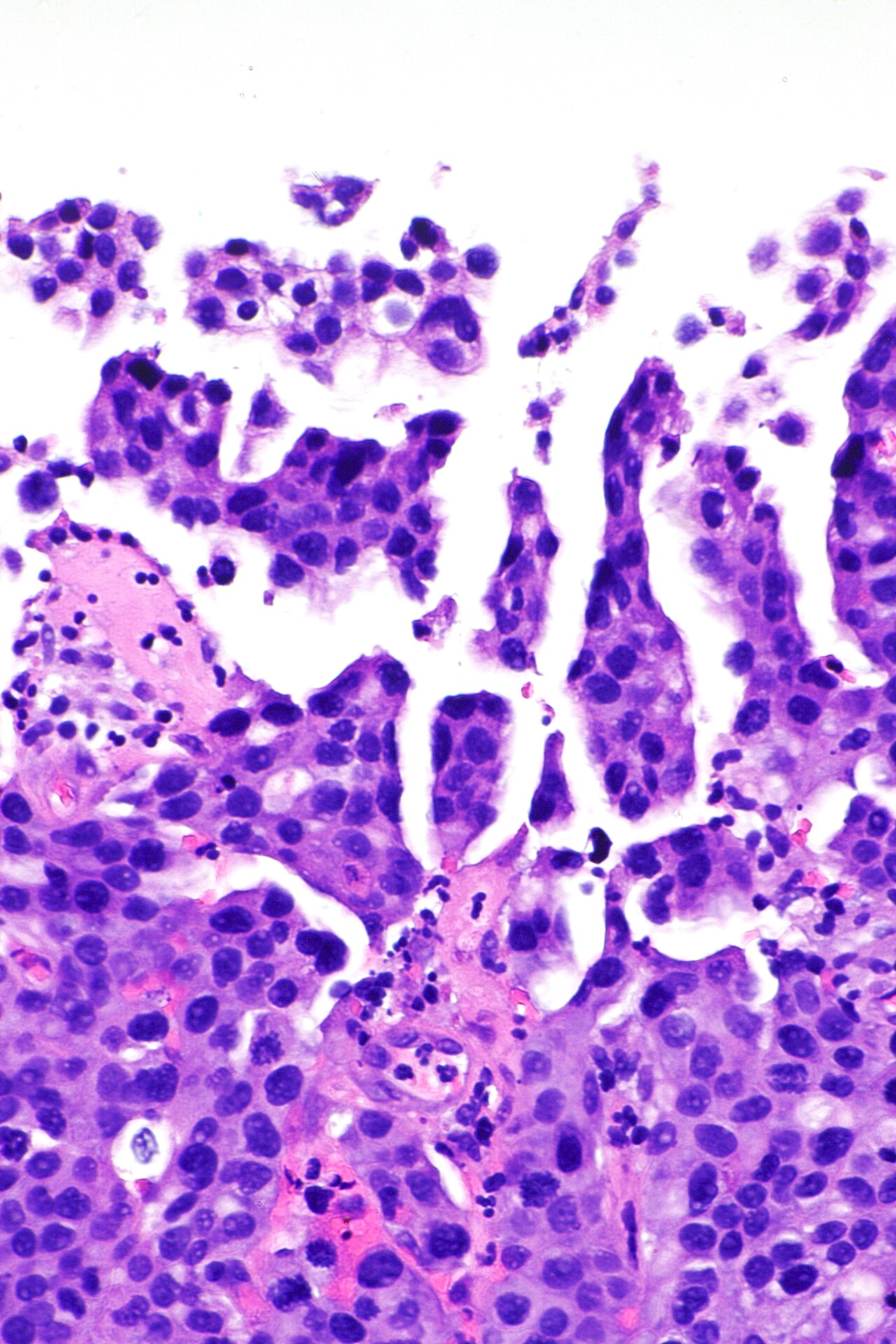 Micrograph showing micropapillary urothelial carcinoma also