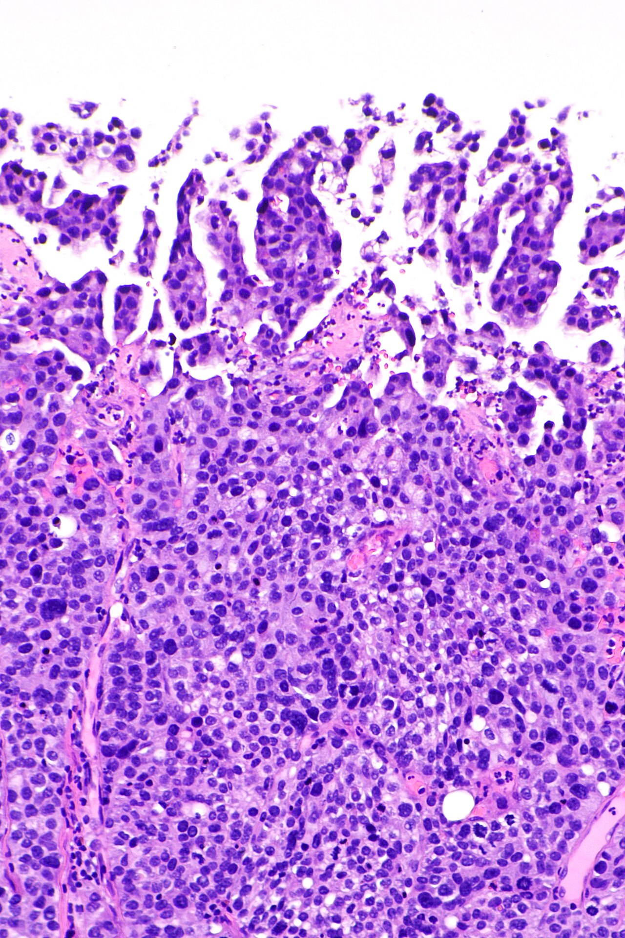 Micrograph showing micropapillary urothelial carcinoma also