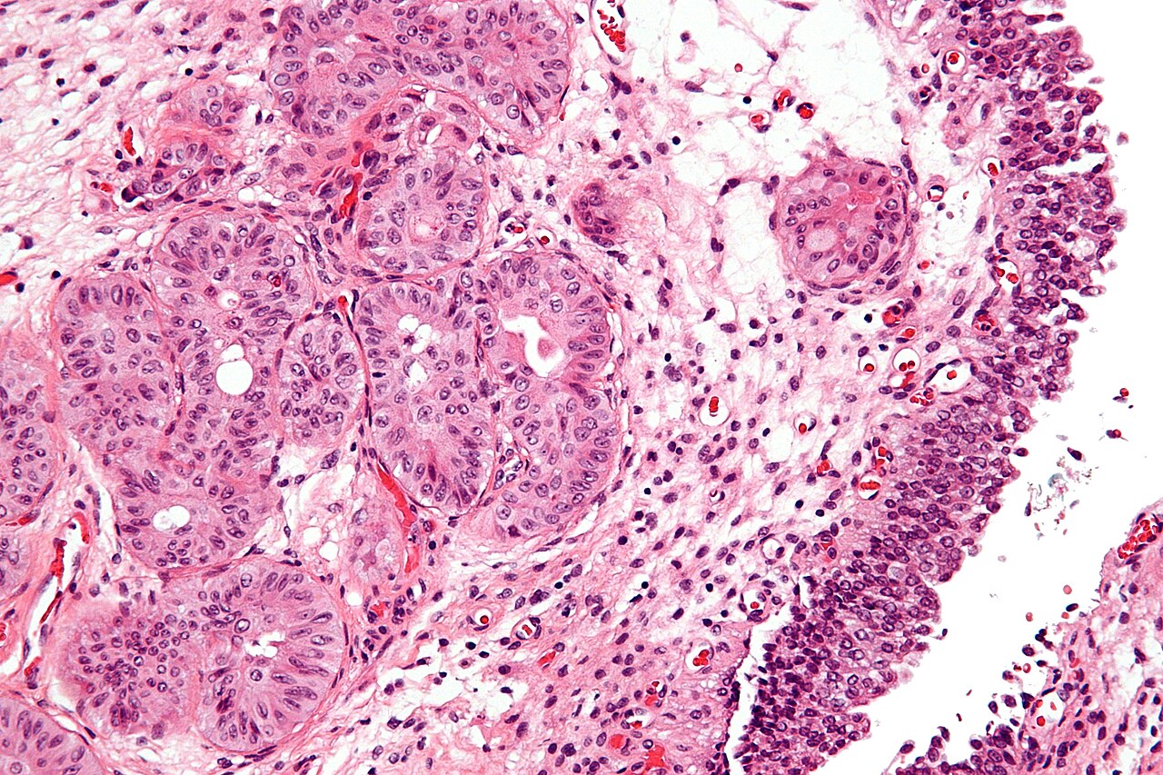 High magnification micrograph of nested variant of urothelia