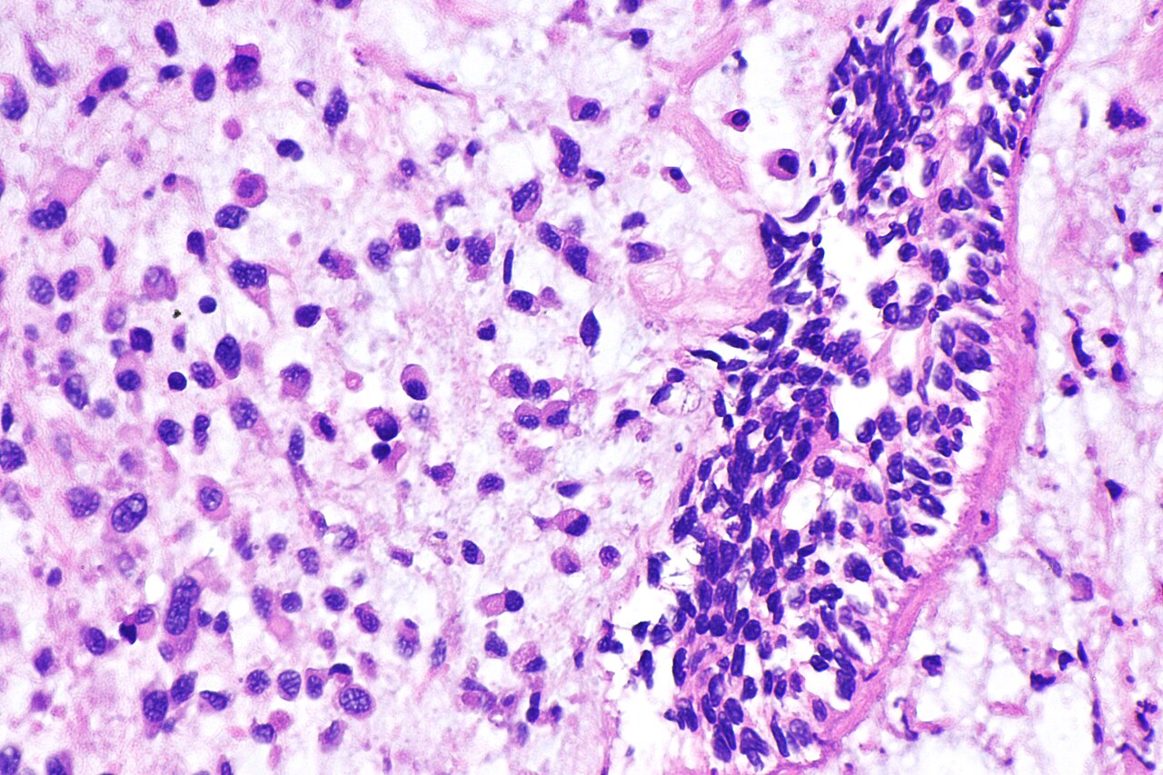 Micrograph of plasmacytoid urothelial carcinoma also plasmac